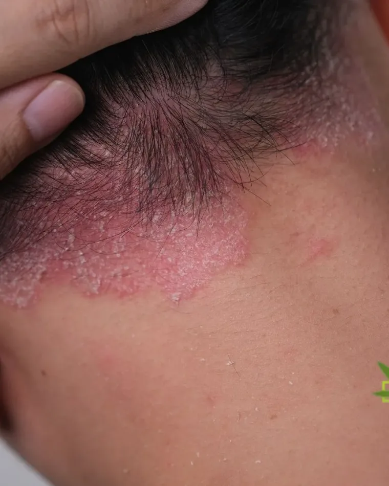 Czy marihuana medyczna zmniejsza świąd i problemy skórne? Nowe spojrzenie na dermatologię